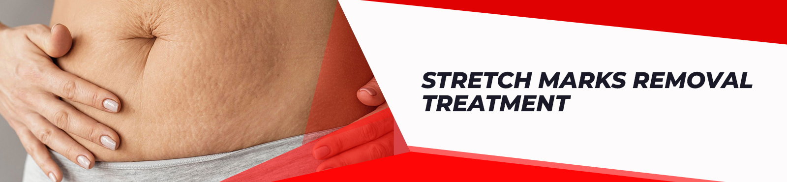 Stretch Marks Removal Treatment