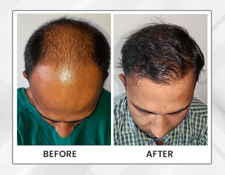 PRP Hair Treatment - Dr Paul Online