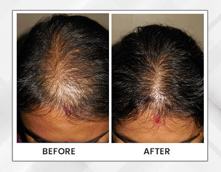 PDO Hair Regrowth Treatment - Dr Paul Online