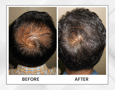 Hair loss treatment