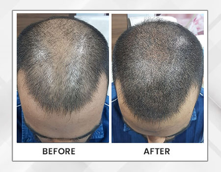 Hair Transplant Clinic Guwahati | Hair Loss Treatment in Guwahati