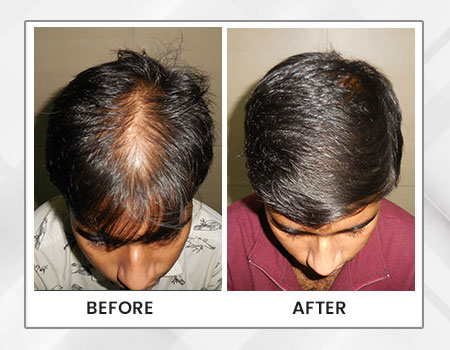 Hair Loss treatment