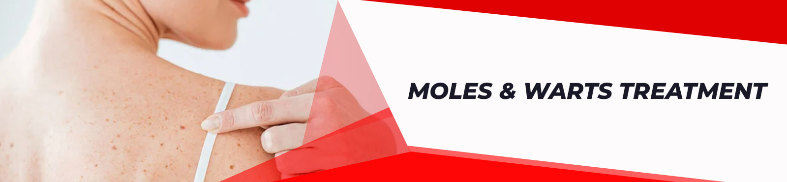 Moles & Warts Treatment