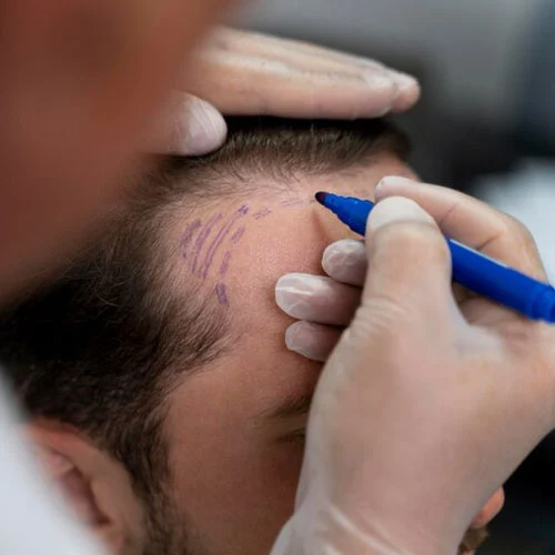 Hair Transplant in Kolkata