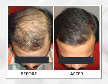 Painless Hair Transplant in kolkata