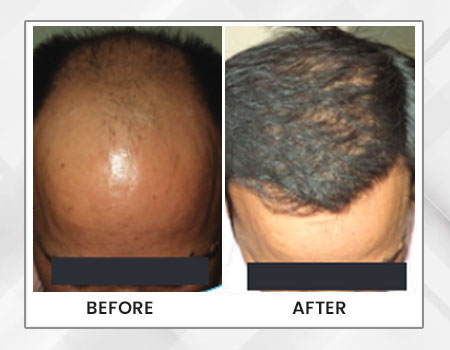 Hair Transplant