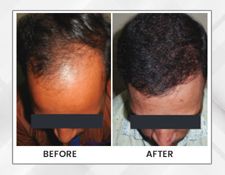 Painless Hair Transplant