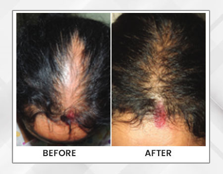Painless Hair Transplant in kolkata