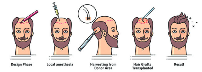 Painless Hair Transplant