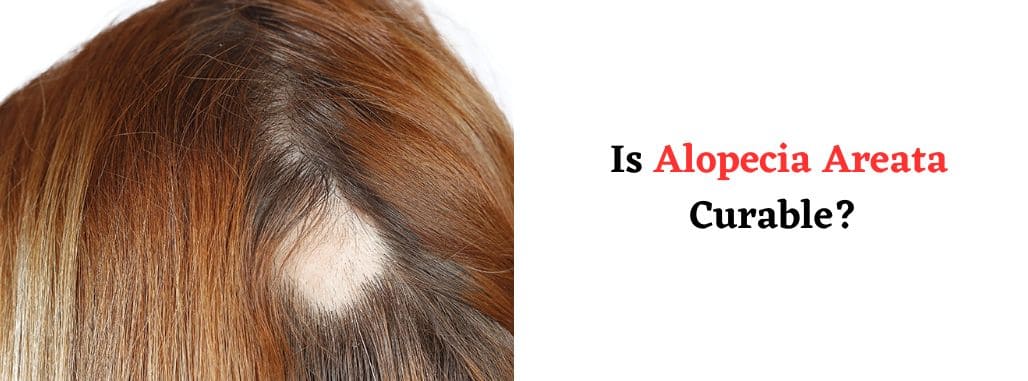 Is Alopecia Areata Curable?