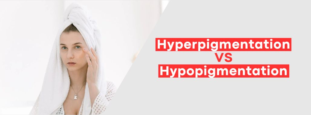Hyperpigmentation VS Hypopigmentation – What Should You Know?