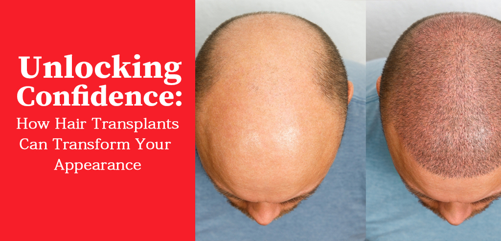 Unlocking Confidence: How Hair Transplants Can Transform Your Appearance