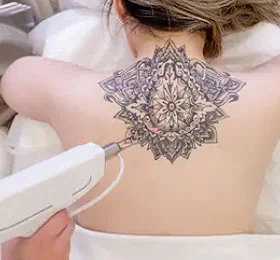 Tatoo Removal