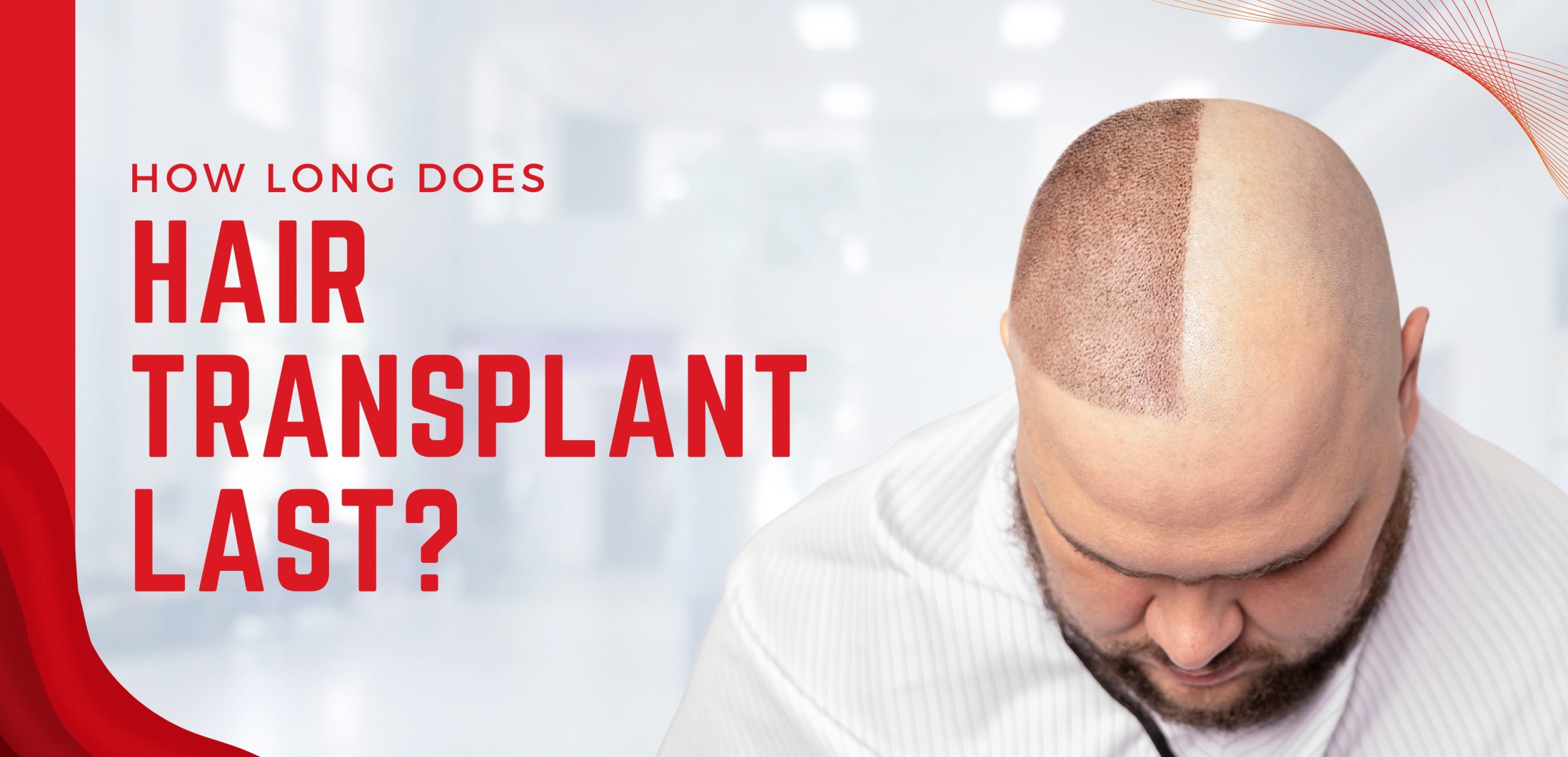 How Long Does Hair Transplant Last?