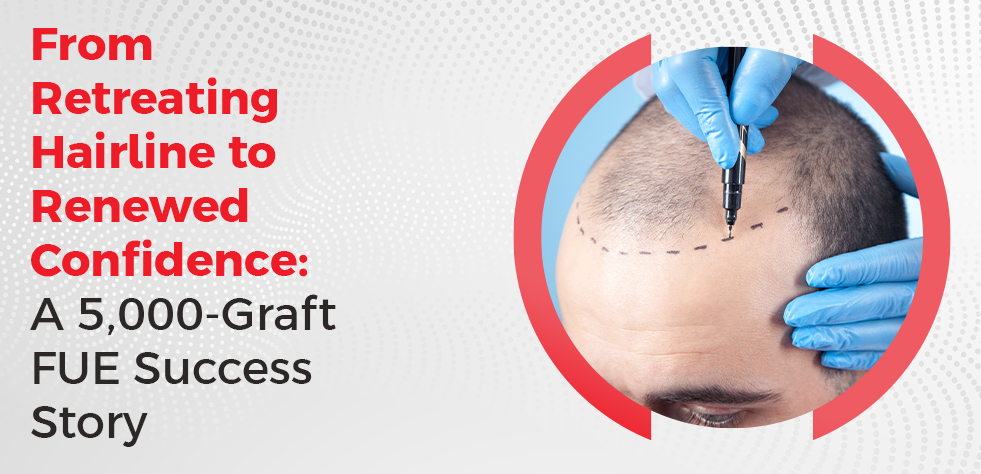 From Retreating Hairline to Renewed Confidence: A 5,000-Graft FUE Success Story