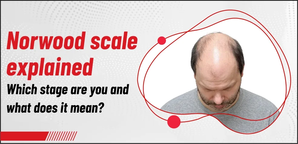 Norwood Scale Explained—Which Stage Are You and What Does It Mean?