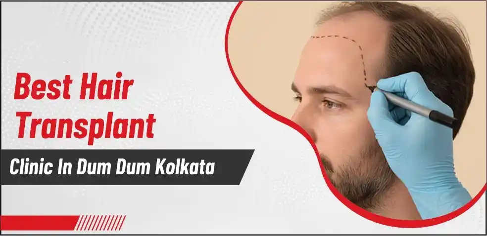 Best Hair Transplant Centre in Dum Dum Kolkata