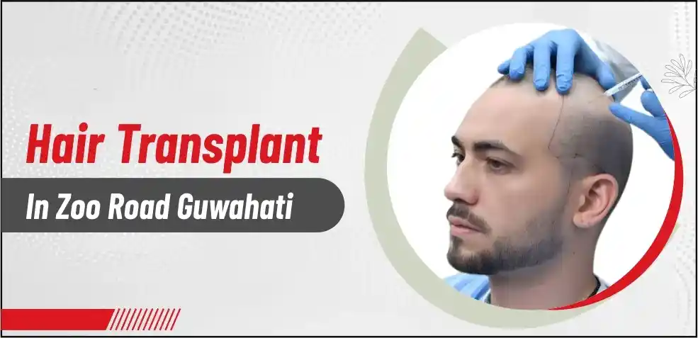 Best Hair Transplant Centre in Zoo Road Guwahati